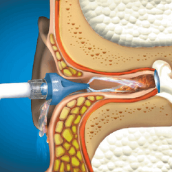 OtoClear® Ausų purškimo plovimo prietaisas